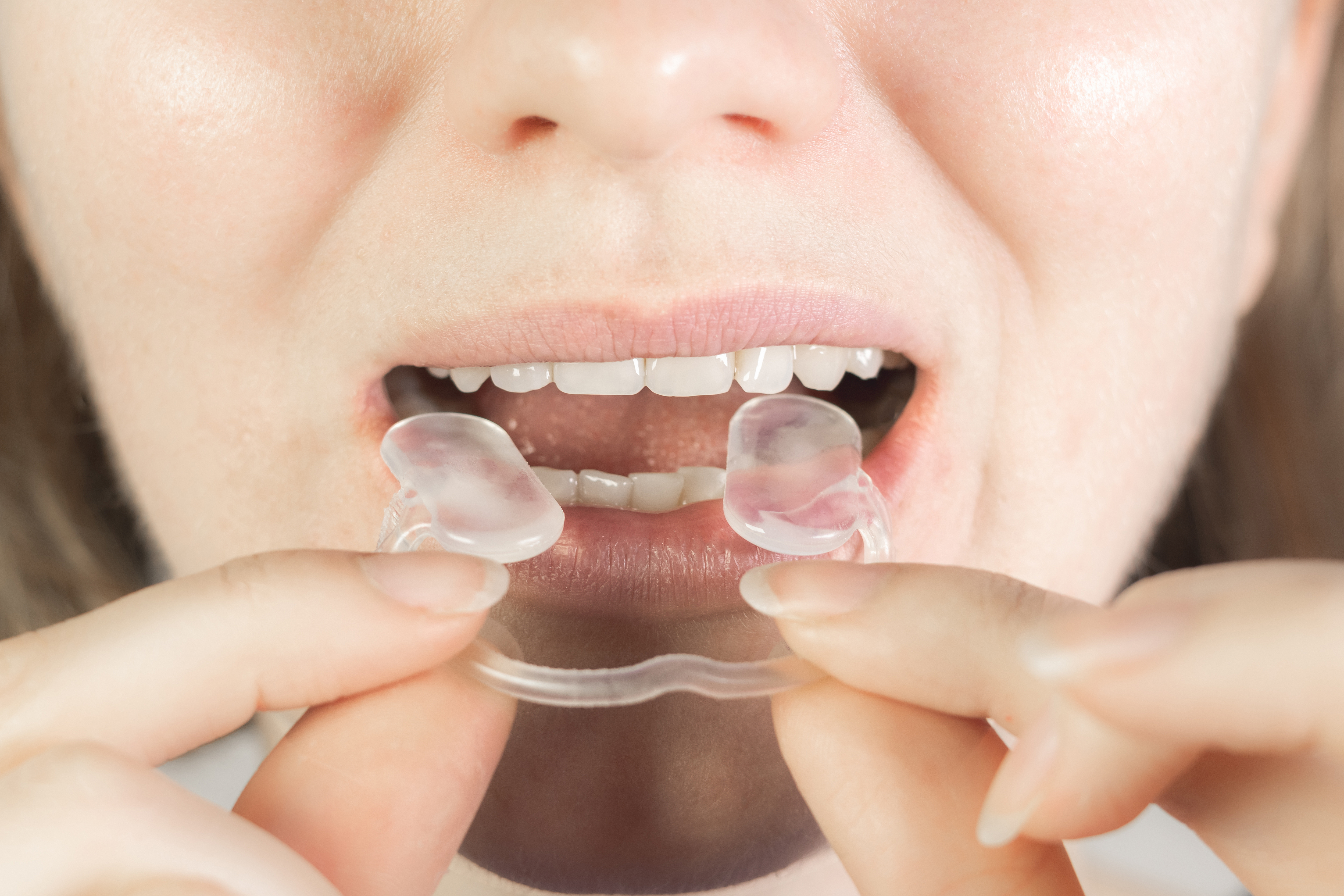 Woman with night guard — TMJ treatment