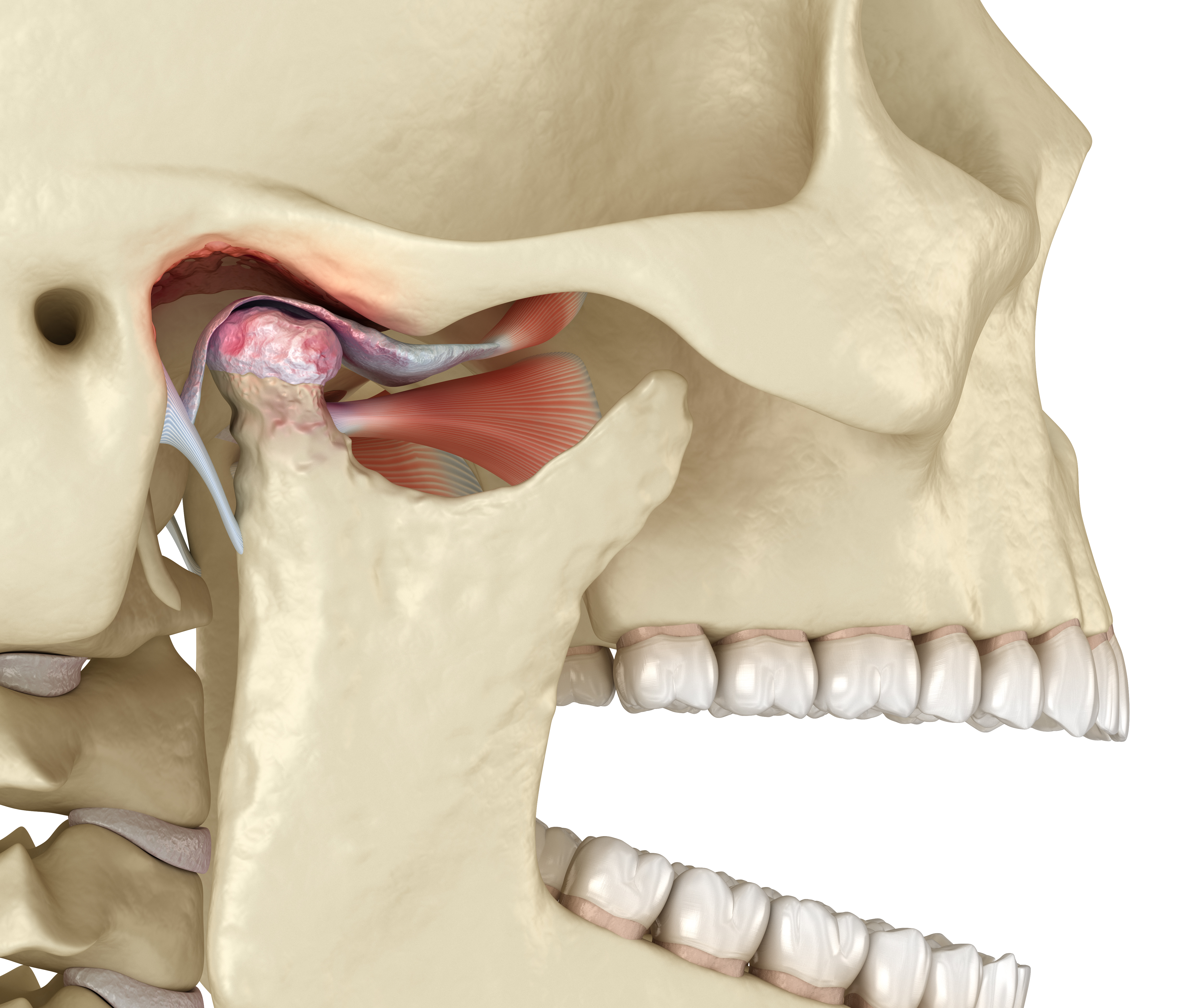 TMJ disorder — dislocated disc illustration